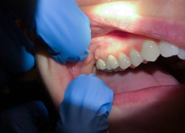 Best Emergency Denture Repair in Short Hills, NJ